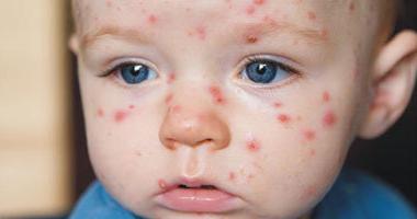 Enterovirové infekce u dítěte: léčba, symptomy, prevence