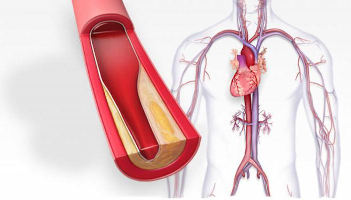 Cholesterolové plaky v cévách: příčiny vzniku, symptomy, důsledky. Jak čistit krevní cévy z plaků?