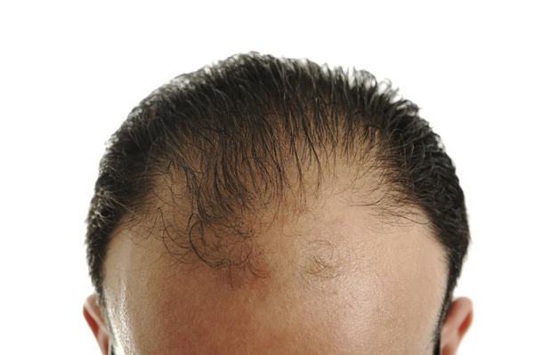 zda je možné vyléčit androgenní alopecii