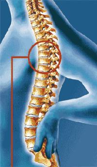 osteophyty hrudní páteře 