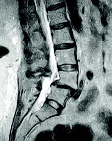 osteophyty cervikální páteře 