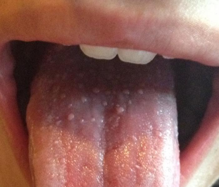 červené pupínky u kořene jazyka