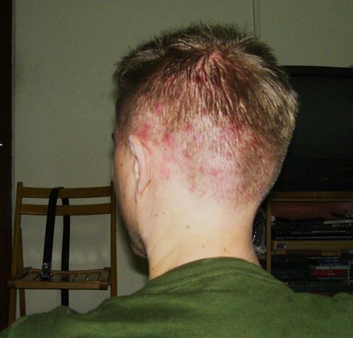 Akné na hlavě pod vlasy: příčiny vzhledu a charakteristik léčby