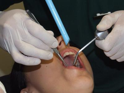 Extrakce moudrosti zubů, kolik se léčí