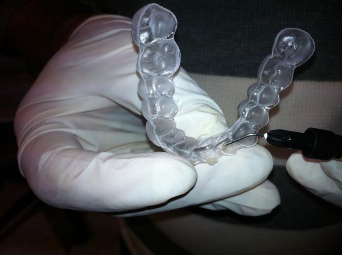 Zarovnání zubů v ortodoncii